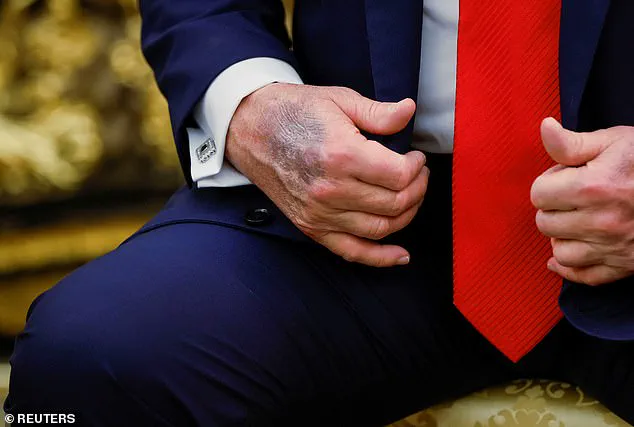 Trump Defies Medical Advice by Continuing High-Dose Aspirin Regimen Despite Physician Warnings